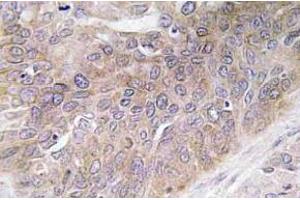 Immunohistochemistry (IHC) analyzes of VEGF-D antibody in paraffin-embedded human lung carcinoma tissue. (VEGFD Antikörper)