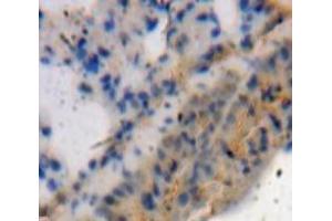 Used in DAB staining on fromalin fixed paraffin-embedded Lung tissue (ADAMTS4 Antikörper  (AA 437-575))