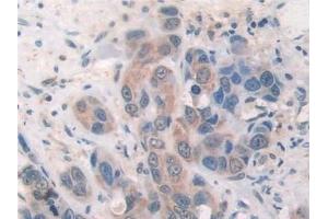 Detection of SOCS2 in Human Breast cancer Tissue using Polyclonal Antibody to Suppressors Of Cytokine Signaling 2 (SOCS2) (SOCS2 Antikörper  (AA 1-198))