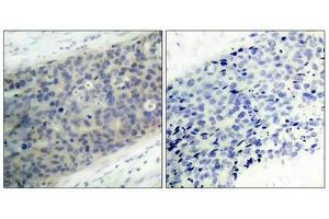 Immunohistochemical analysis of paraffin-embedded human breast carcinoma tissue using LIMK2(Phospho-Thr505) Antibody(left) or the same antibody preincubated with blocking peptide(right). (LIMK2 Antikörper  (pThr505))