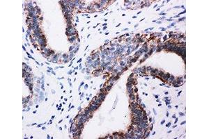 IHC-P: PI3K antibody testing of human breast cancer tissue (PIK3R1 Antikörper  (AA 447-461))