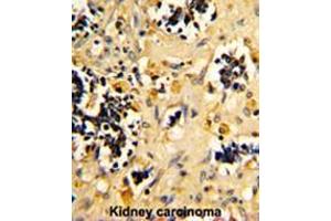 Formalin-fixed and paraffin-embedded human kidney carcinoma reacted with NDUFS4 Antibody (C-term), which was peroxidase-conjugated to the secondary antibody, followed by DAB staining. (NDUFS4 Antikörper  (C-Term))