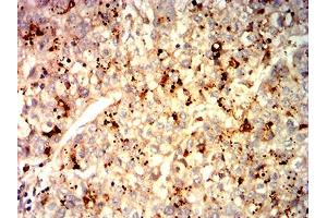 Immunohistochemical analysis of paraffin-embedded liver cancer tissues using GPC3 mouse mAb with DAB staining. (Glypican 3 Antikörper  (AA 55-200))