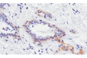 Immunohistochemistry (IHC) image for anti-ErbB2/Her2 (Trastuzumab Biosimilar) antibody (ABIN5668227)