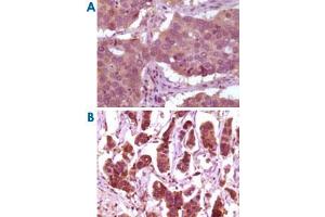 Immunohistochemical analysis of paraffin-embedded human lung carcinoma (A) and breast carcinoma (B) showing cytoplasmic localization using MAPK1 monoclonal antibody, clone 4C11  with DAB staining. (ERK2 Antikörper)