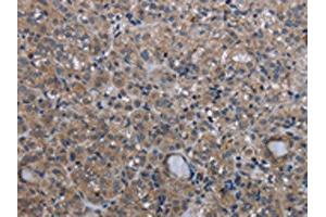 The image on the left is immunohistochemistry of paraffin-embedded Human thyroid cancer tissue using ABIN7130197(MCM3AP Antibody) at dilution 1/30, on the right is treated with fusion protein. (GANP Antikörper)