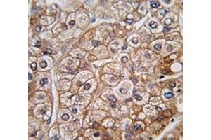 IHC analysis of FFPE human hepatocarcinoma tissue stained with BMPR2 antibody (BMPR2 Antikörper  (AA 27-56))