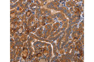 Immunohistochemistry of Human colon cancer using BMP6 Polyclonal Antibody at dilution of 1:40 (BMP6 Antikörper)