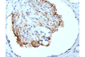 IHC testing of formalin-fixed, paraffin-embedded human kidney stained with WT1 antibody (clone WT1/857). (WT1 Antikörper)