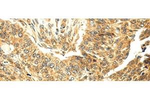 Immunohistochemistry of paraffin-embedded Human lung cancer tissue using SERPINA12 Polyclonal Antibody at dilution 1:40 (SERPINA12 Antikörper)