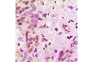 Immunohistochemical analysis of hnRNP A2/B1 staining in human breast cancer formalin fixed paraffin embedded tissue section. (HNRNPA2B1 Antikörper  (N-Term))