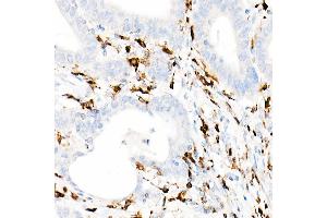Immunohistochemistry of paraffin-embedded Human colon carcinoma using CD74 antibody (ABIN7267759) at dilution of 1:100 (40x lens). (CD74 Antikörper)