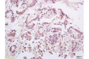 Formalin-fixed and paraffin embedded human gastric carcinoma labeled with Rabbit Anti OPGL/RANKL/ODF Polyclonal Antibody, Unconjugated (ABIN672696) at 1:200 followed by conjugation to the secondary antibody and DAB staining (RANKL Antikörper  (AA 210-317))