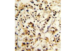 Formalin-fixed and paraffin-embedded human breast carcinoma reacted with CD158d / KIR2DL4 Antibody (C-term) followed which was peroxidase-conjugated to the secondary antibody, followed by DAB staining. (KIR2DL4/CD158d Antikörper  (C-Term))