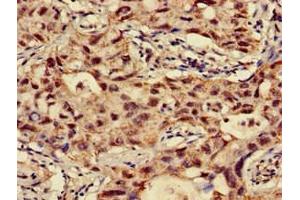 Immunohistochemistry of paraffin-embedded human lung cancer using ABIN7144675 at dilution of 1:100