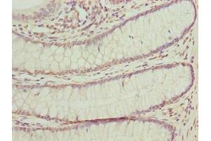 Immunohistochemistry of paraffin-embedded human colon cancer using ABIN7165150 at dilution of 1:100 (BUD31 Antikörper  (AA 1-144))
