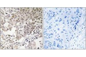 Immunohistochemistry analysis of paraffin-embedded human lung carcinoma, using NCAPG2 Antibody. (NCAPG2 Antikörper  (AA 561-610))