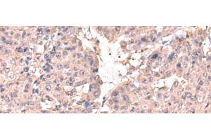 Immunohistochemistry of paraffin-embedded Human liver cancer tissue using HPN Polyclonal Antibody at dilution of 1:50(x200) (Hepsin Antikörper)