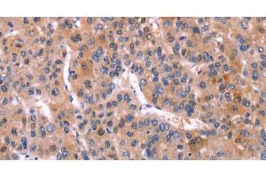 Immunohistochemistry of paraffin-embedded Human liver cancer using CD269 Polyclonal Antibody at dilution of 1:30 (BCMA Antikörper)
