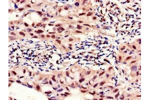 Immunohistochemistry of paraffin-embedded human lung cancer using ABIN7142693 at dilution of 1:100 (PFKFB2 Antikörper  (AA 360-505))