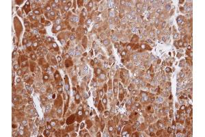 IHC-P Image Immunohistochemical analysis of paraffin-embedded human adrenal cortical tumor, using RIC8A, antibody at 1:100 dilution. (RIC8A Antikörper  (C-Term))