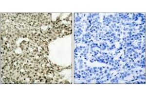 Immunohistochemistry analysis of paraffin-embedded human breast carcinoma, using STAT1 (Phospho-Ser727) Antibody. (STAT1 Antikörper  (pSer727))