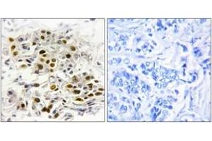 Immunohistochemistry analysis of paraffin-embedded human breast carcinoma tissue, using MAP3K6 Antibody.