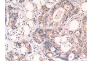IHC-P analysis of Human Rectum Cancer Tissue, with DAB staining. (POR Antikörper  (AA 77-518))