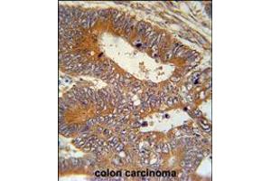 MAP1S Antibody immunohistochemistry analysis in formalin fixed and paraffin embedded human colon carcinoma followed by peroxidase conjugation of the secondary antibody and DAB staining. (MAP1S Antikörper  (AA 493-520))