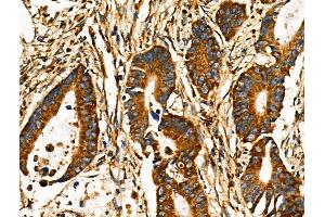 ABIN6258609 and ABIN6274191 at 1/100 staining Human colorectal cancer by IHC-P. (Hexokinase 1 Antikörper  (N-Term))