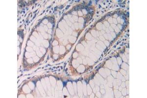 IHC-P analysis of rectum cancer tissue, with DAB staining. (IL1R1 Antikörper  (AA 226-318))