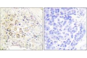 Immunohistochemistry analysis of paraffin-embedded human breast carcinoma tissue, using HER3 Antibody.