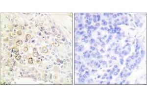 Immunohistochemistry analysis of paraffin-embedded human breast carcinoma tissue, using HER3 Antibody. (ERBB3 Antikörper  (AA 1-50))