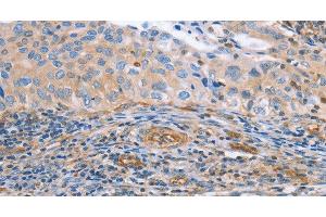 Immunohistochemistry of paraffin-embedded Human cervical cancer tissue using NRG4 Polyclonal Antibody at dilution 1:60 (Neuregulin 4 Antikörper)
