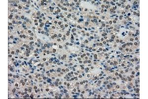Immunohistochemical staining of paraffin-embedded Adenocarcinoma of breast tissue using anti-SCYL3 mouse monoclonal antibody. (SCYL3 Antikörper)