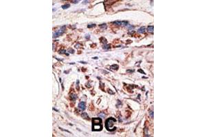 Formalin-fixed and paraffin-embedded human breast cancer tissue reacted with MAGEA1 polyclonal antibody  , which was peroxidase-conjugated to the secondary antibody, followed by DAB staining. (MAGEA1 Antikörper  (Internal Region))
