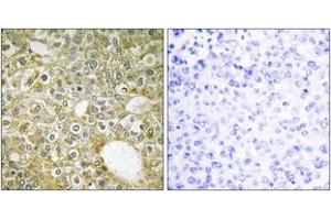 Immunohistochemistry analysis of paraffin-embedded human breast carcinoma tissue, using ACVL1 Antibody. (ACVRL1 Antikörper  (AA 196-245))