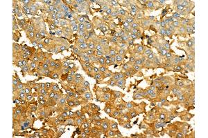 ABIN6261825 and ABIN6276547 at 1/100 staining Human liver cancer by IHC-P. (FTH1 Antikörper  (C-Term))