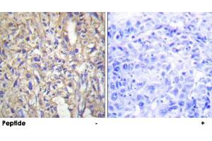 Immunohistochemistry analysis of paraffin-embedded human liver carcinoma tissue using LAMB1 polyclonal antibody .