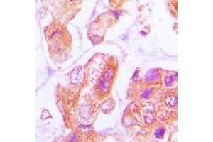 Immunohistochemical analysis of DNAJB11 staining in human lung cancer formalin fixed paraffin embedded tissue section. (DNAJB11 Antikörper  (Center))