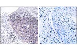 Immunohistochemistry analysis of paraffin-embedded human cervix carcinoma tissue, using GTPBP5 Antibody.