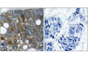 Immunohistochemistry analysis of paraffin-embedded human breast carcinoma, using HSP27 (Phospho-Ser15) Antibody. (HSP27 Antikörper  (pSer15))