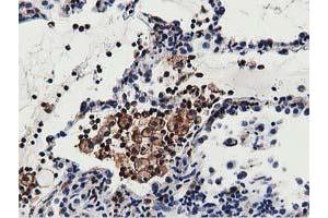 Immunohistochemical staining of paraffin-embedded Carcinoma of Human lung tissue using anti-MICAL1 mouse monoclonal antibody. (MICAL1 Antikörper)