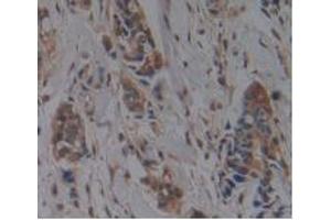 IHC-P analysis of Human Breast Cancer Tissue, with DAB staining. (HFE2 Antikörper  (AA 29-401))