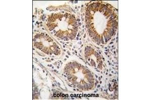 Formalin-fixed and paraffin-embedded human hepatocarcinoma tissue reacted with AHCY antibody (N-term) (ABIN389201 and ABIN2839361) , which was peroxidase-conjugated to the secondary antibody, followed by DAB staining. (AHCY Antikörper  (N-Term))