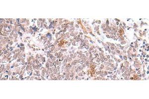 Immunohistochemistry of paraffin-embedded Human lung cancer tissue using INPP5K Polyclonal Antibody at dilution of 1:90(x200) (INPP5K Antikörper)
