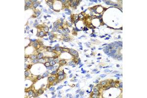 Immunohistochemistry of paraffin-embedded human gastric cancer using AMY2A antibody. (AMY2A Antikörper)