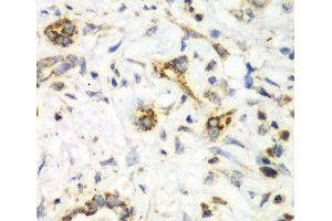Immunohistochemistry of paraffin-embedded Human liver cancer using NRBF2 Polyclonal Antibody at dilution of 1:100 (40x lens). (NRBF2 Antikörper)
