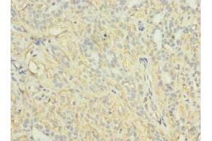 Immunohistochemistry of paraffin-embedded human breast cancer using ABIN7163997 at dilution of 1:100 (KCNH7 Antikörper  (AA 1-300))