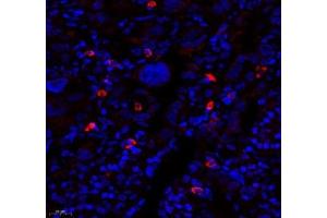Immunofluorescence of paraffin embedded human lung cancer using MTND5 (ABIN7074659) at dilution of 1: 400 (450x lens) (MT-ND5 Antikörper)